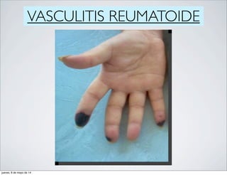 VASCULITIS REUMATOIDE
jueves, 8 de mayo de 14
 