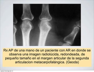 Rx AP de una mano de un paciente con AR en donde se
observa una imagen radiolúcida, redondeada, de
pequeño tamaño en el margen articular de la segunda
articulacion metacarpofalángica. (Geoda)
jueves, 8 de mayo de 14
 