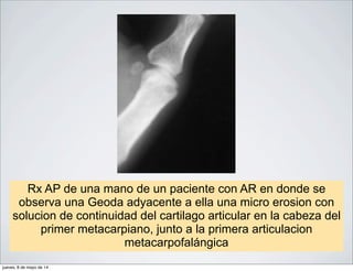 Rx AP de una mano de un paciente con AR en donde se
observa una Geoda adyacente a ella una micro erosion con
solucion de continuidad del cartilago articular en la cabeza del
primer metacarpiano, junto a la primera articulacion
metacarpofalángica
jueves, 8 de mayo de 14
 