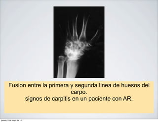 Fusion entre la primera y segunda linea de huesos del
carpo.
signos de carpitis en un paciente con AR.
jueves, 8 de mayo de 14
 