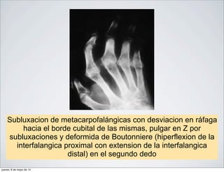 Subluxacion de metacarpofalángicas con desviacion en ráfaga
hacia el borde cubital de las mismas, pulgar en Z por
subluxaciones y deformida de Boutonniere (hiperflexion de la
interfalangica proximal con extension de la interfalangica
distal) en el segundo dedo
jueves, 8 de mayo de 14
 