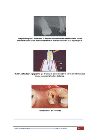 Postes intrarradiculares---------------------------------------------------Integral del Adulto 11
 
