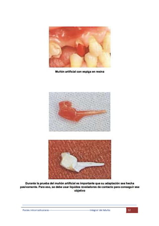 Postes intrarradiculares---------------------------------------------------Integral del Adulto 12
 