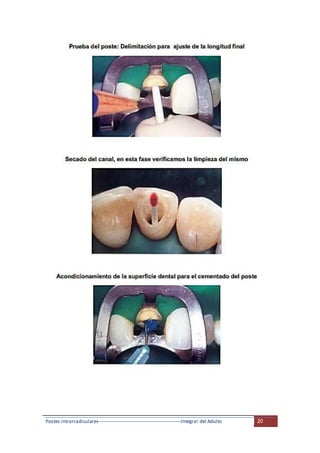 Postes intrarradiculares---------------------------------------------------Integral del Adulto 20
 