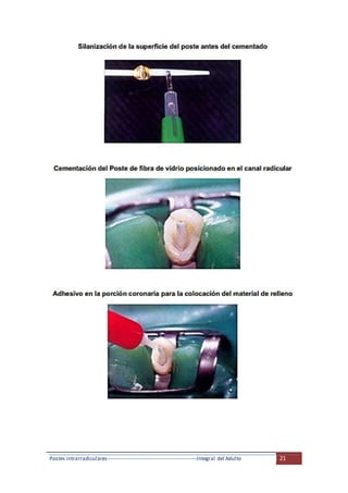 Postes intrarradiculares---------------------------------------------------Integral del Adulto 21
 