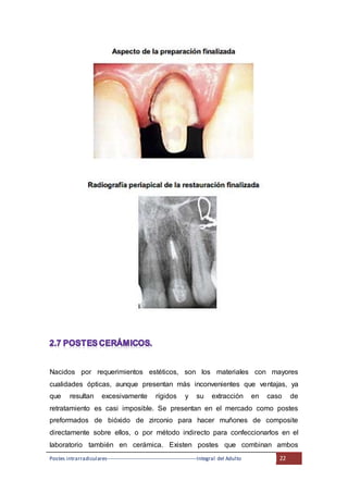 Postes intrarradiculares---------------------------------------------------Integral del Adulto 22
Nacidos por requerimientos estéticos, son los materiales con mayores
cualidades ópticas, aunque presentan más inconvenientes que ventajas, ya
que resultan excesivamente rígidos y su extracción en caso de
retratamiento es casi imposible. Se presentan en el mercado como postes
preformados de bióxido de zirconio para hacer muñones de composite
directamente sobre ellos, o por método indirecto para confeccionarlos en el
laboratorio también en cerámica. Existen postes que combinan ambos
 