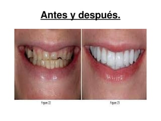 Antes y después. 
 