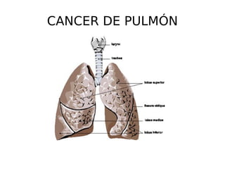 CANCER DE PULMÓN 