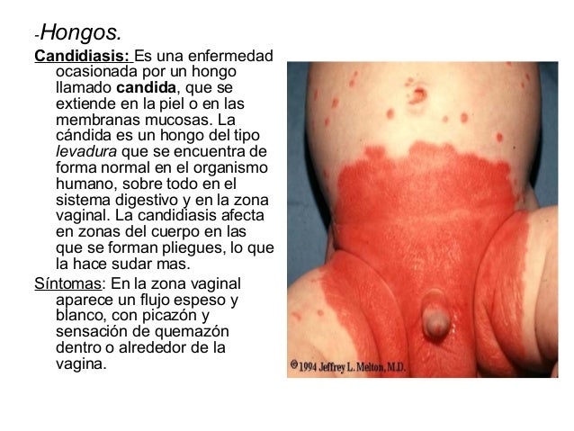 Si no curar la psoriasis de las uñas
