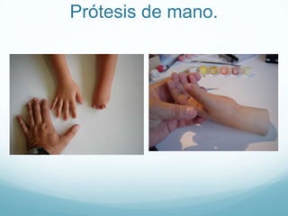 Prótesis de mano.