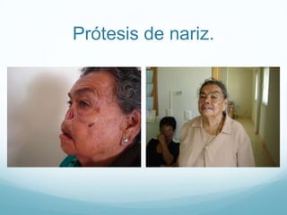 Prótesis de nariz.