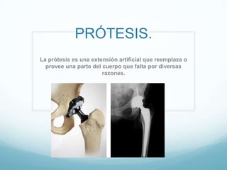 PRÓTESIS. La prótesis es una extensión artificial que reemplaza o provee una parte del cuerpo que falta por diversas razones. 