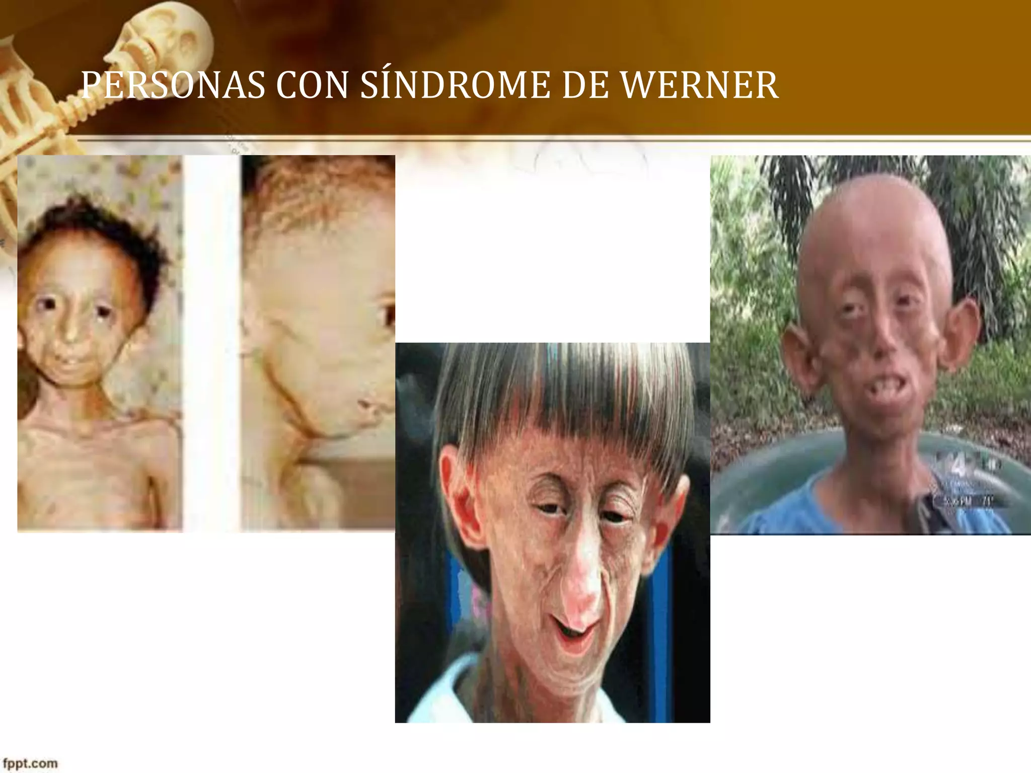 SÍNDROME DE EDWARDS Y WERNER PPT
