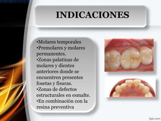 INDICACIONES

•Molares temporales
•Premolares y molares
permanentes.
•Zonas palatinas de
molares y dientes
anteriores donde se
encuentren presentes
fosetas y fisuras.
•Zonas de defectos
estructurales en esmalte.
•En combinación con la
resina preventiva
 