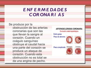 ANGINA DE PECHO :Es el dolor producido en el pecho cuando no llega suficiente aporte sanguíneo al corazón. 