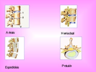 Artrosis Hernia discal Espondilolisis Protusión 
