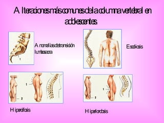 Alteraciones más comunes de la columna vertebral en adolescentes.   Anomalías de transición lumbosacra Escoliosis Hipercifosis Hiperlordosis 