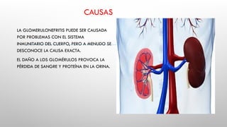 CAUSAS
LA GLOMERULONEFRITIS PUEDE SER CAUSADA
POR PROBLEMAS CON EL SISTEMA
INMUNITARIO DEL CUERPO, PERO A MENUDO SE
DESCONOCE LA CAUSA EXACTA.
EL DAÑO A LOS GLOMÉRULOS PROVOCA LA
PÉRDIDA DE SANGRE Y PROTEÍNA EN LA ORINA.
 