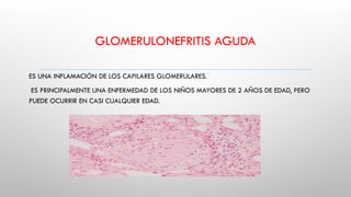 GLOMERULONEFRITIS AGUDA
ES UNA INFLAMACIÓN DE LOS CAPILARES GLOMERULARES.
ES PRINCIPALMENTE UNA ENFERMEDAD DE LOS NIÑOS MAYORES DE 2 AÑOS DE EDAD, PERO
PUEDE OCURRIR EN CASI CUALQUIER EDAD.
 