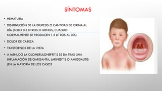 SÍNTOMAS
• HEMATURIA
• DISMINUCIÓN DE LA DIURESIS O CANTIDAD DE ORINA AL
DÍA (SOLO 0.5 LITROS O MENOS, CUANDO
NORMALMENTE SE PRODUCEN 1.5 LITROS AL DÍA)
• DOLOR DE CABEZA
• TRASTORNOS DE LA VISTA
• A MENUDO LA GLOMERULONEFRITIS SE DA TRAS UNA
INFLAMACIÓN DE GARGANTA, LARINGITIS O AMIGDALITIS
(EN LA MAYORÍA DE LOS CASOS
 