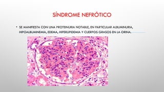SÍNDROME NEFRÓTICO
• SE MANIFIESTA CON UNA PROTEINURIA NOTABLE, EN PARTICULAR ALBUMINURIA,
HIPOALBUMINEMIA, EDEMA, HIPERLIPIDEMIA Y CUERPOS GRASOS EN LA ORINA.
 