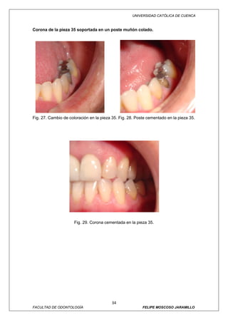 UNIVERSIDAD CATÓLICA DE CUENCA



Corona de la pieza 35 soportada en un poste muñón colado.




Fig. 27. Cambio de coloración en la pieza 35. Fig. 28. Poste cementado en la pieza 35.




                      Fig. 29. Corona cementada en la pieza 35.




                                          34
FACULTAD DE ODONTOLOGÍA                                   FELIPE MOSCOSO JARAMILLO
 