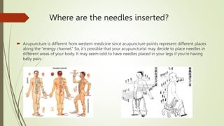 Acupuncture Method acupunture | PPTX