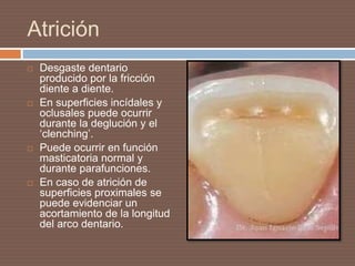 Atrición
 Desgaste dentario
producido por la fricción
diente a diente.
 En superficies incídales y
oclusales puede ocurrir
durante la deglución y el
‘clenching’.
 Puede ocurrir en función
masticatoria normal y
durante parafunciones.
 En caso de atrición de
superficies proximales se
puede evidenciar un
acortamiento de la longitud
del arco dentario.
 