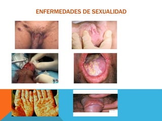 ENFERMEDADES DE SEXUALIDAD
 