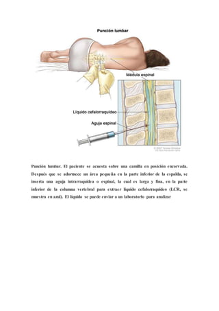 Punción lumbar. El paciente se acuesta sobre una camilla en posición encorvada.
Después que se adormece un área pequeña en la parte inferior de la espalda, se
inserta una aguja intrarraquídea o espinal, la cual es larga y fina, en la parte
inferior de la columna vertebral para extraer líquido cefalorraquídeo (LCR, se
muestra en azul). El líquido se puede enviar a un laboratorio para analizar
 