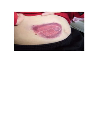 LEUCEMIA LINFOBLASTICA AGUDA