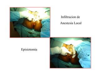 Infiltracion de
Anestesia Local
Episiotomia
 