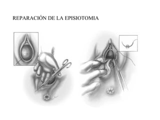 REPARACIÓN DE LA EPISIOTOMIA
 