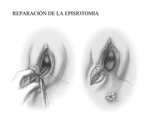REPARACIÓN DE LA EPISIOTOMIA
 