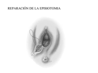 REPARACIÓN DE LA EPISIOTOMIA
 