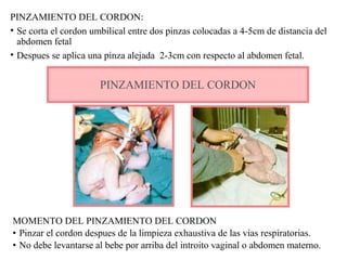PINZAMIENTO DEL CORDON:
• Se corta el cordon umbilical entre dos pinzas colocadas a 4-5cm de distancia del
abdomen fetal
• Despues se aplica una pinza alejada 2-3cm con respecto al abdomen fetal.
PINZAMIENTO DEL CORDON
MOMENTO DEL PINZAMIENTO DEL CORDON
• Pinzar el cordon despues de la limpieza exhaustiva de las vias respiratorias.
• No debe levantarse al bebe por arriba del introito vaginal o abdomen materno.
 