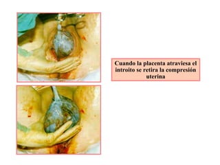 Cuando la placenta atraviesa el
introito se retira la compresión
uterina
 