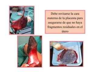 Debe revisarse la cara
materna de la placenta para
asegurarse de que no haya
fragmentos residuales en el
útero
 