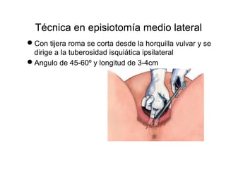 Técnica en episiotomía medio lateral 
Con tijera roma se corta desde la horquilla vulvar y se 
dirige a la tuberosidad isquiática ipsilateral 
Angulo de 45-60º y longitud de 3-4cm 
 
