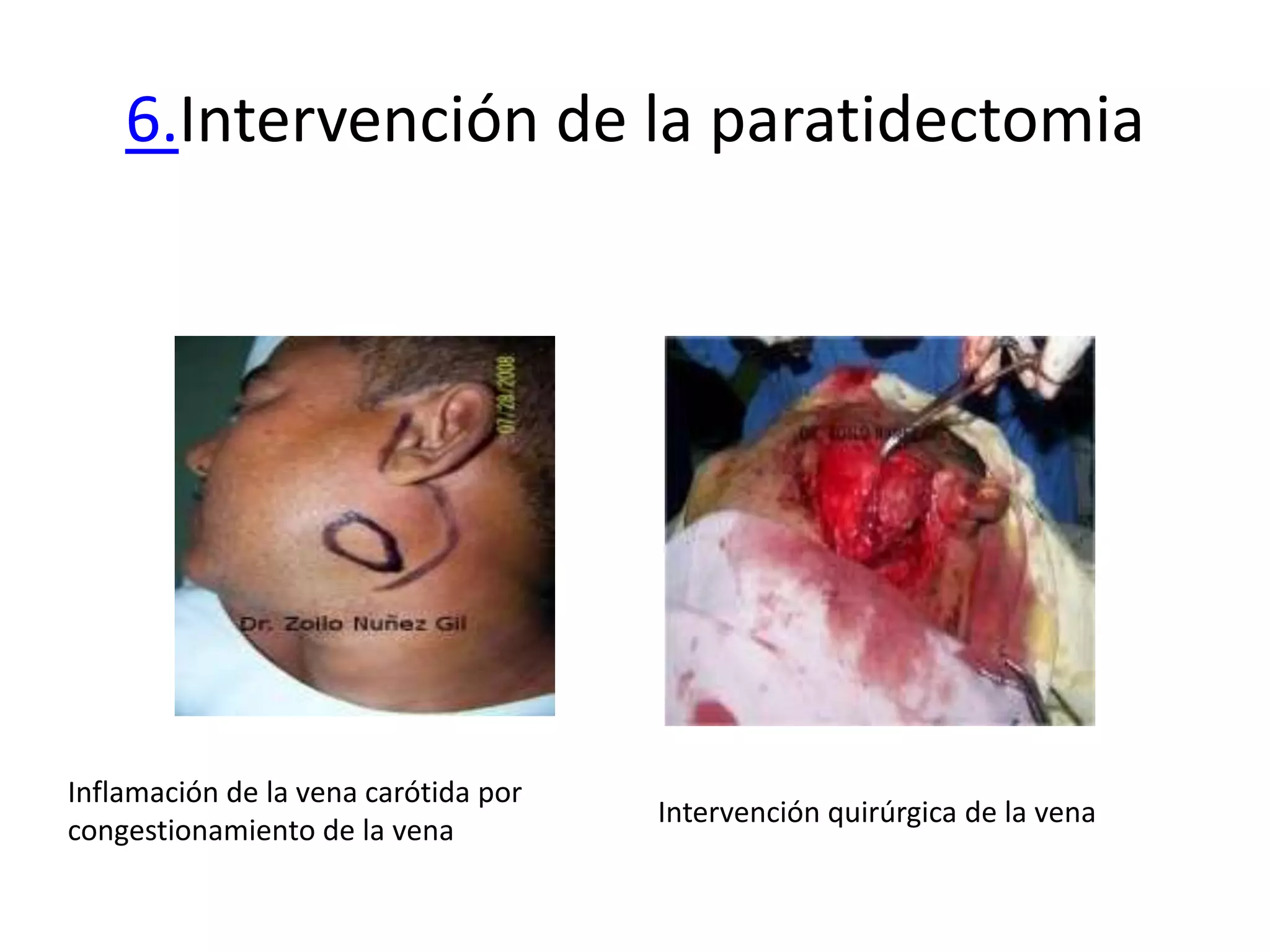6.Intervención de la paratidectomia




Inflamación de la vena carótida por
                                      Intervención quirúrgica de la vena
congestionamiento de la vena
 