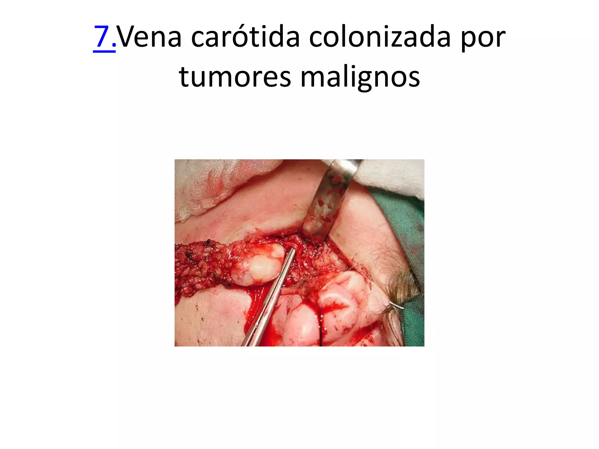 7.Vena carótida colonizada por
      tumores malignos
 