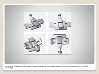 De Sousa V, "O aparelho pré-ajustado: sua evolução e suas prescrições“. Revista Dental. Press Ortodoncia y Ortopedia
Facial.2006
 