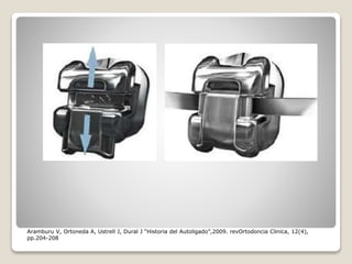 Aramburu V, Ortoneda A, Ustrell J, Dural J “Historia del Autoligado”,2009. revOrtodoncia Clinica, 12(4),
pp.204-208
 