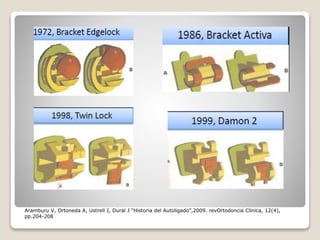 Aramburu V, Ortoneda A, Ustrell J, Dural J “Historia del Autoligado”,2009. revOrtodoncia Clinica, 12(4),
pp.204-208
 