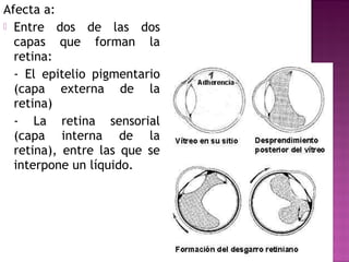 Afecta a:
 Entre dos de las dos
capas que forman la
retina:
- El epitelio pigmentario
(capa externa de la
retina)
- La retina sensorial
(capa interna de la
retina), entre las que se
interpone un líquido.
 