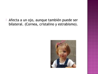  Afecta a un ojo, aunque también puede ser
bilateral. (Cornea, cristalino y estrabismo).
 