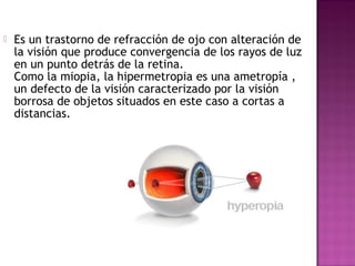 Es un trastorno de refracción de ojo con alteración de
la visión que produce convergencia de los rayos de luz
en un punto detrás de la retina.
Como la miopia, la hipermetropia es una ametropía ,
un defecto de la visión caracterizado por la visión
borrosa de objetos situados en este caso a cortas a
distancias.
 