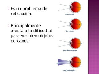 Es un problema de
refraccion.
 Principalmente
afecta a la dificultad
para ver bien objetos
cercanos.
 