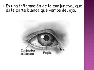  Es una inflamación de la conjuntiva, que
es la parte blanca que vemos del ojo.
 