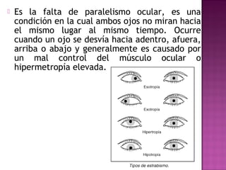  Es la falta de paralelismo ocular, es una
condición en la cual ambos ojos no miran hacia
el mismo lugar al mismo tiempo. Ocurre
cuando un ojo se desvía hacia adentro, afuera,
arriba o abajo y generalmente es causado por
un mal control del músculo ocular o
hipermetropía elevada.
 